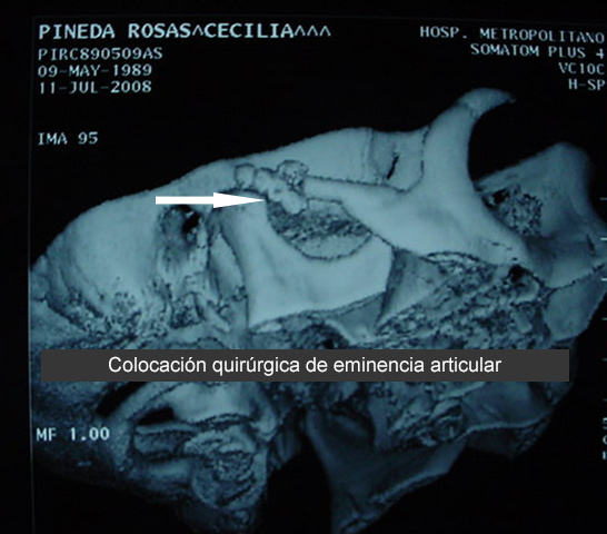 Eminencia articular (caso clínico)