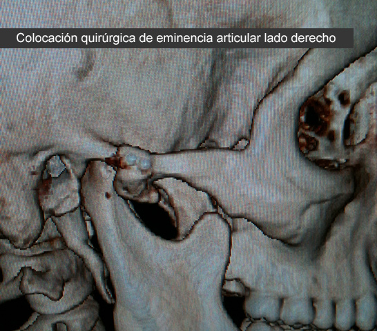 Eminencia articular (caso clínico)