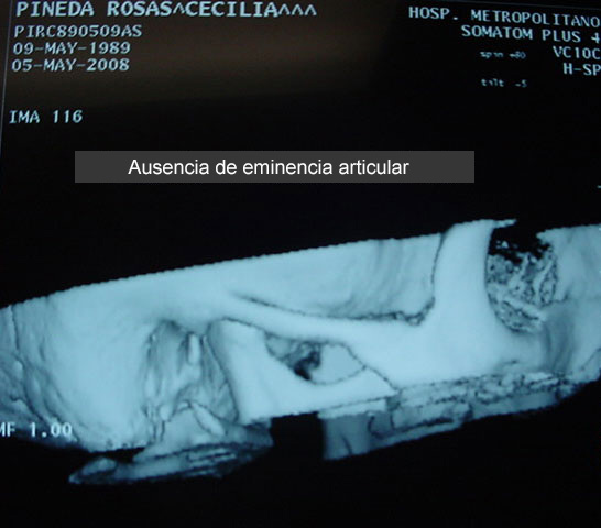 Eminencia articular (caso clínico)