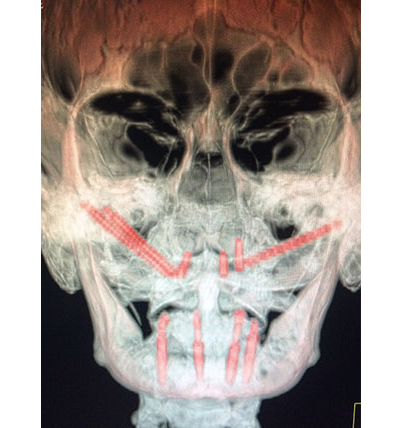 Implantes dentales cigomáticos (referencia)