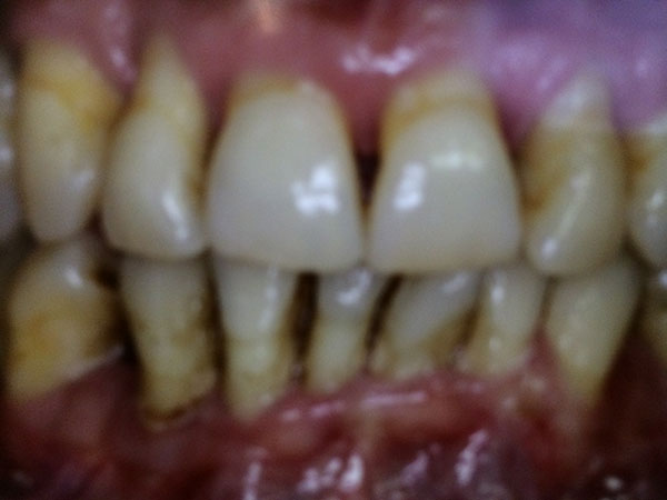 Ventajas de implantes dentales cigomáticos