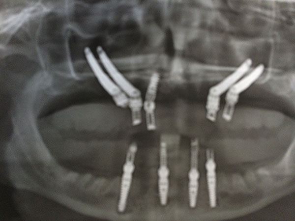 Implantes cigomáticos