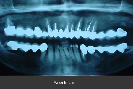 Rehabilitación bucal con implantes dentales