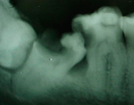 Radiografía de extracción de terceros molares