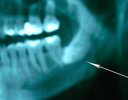 Radiografía de extracción de terceros molares
