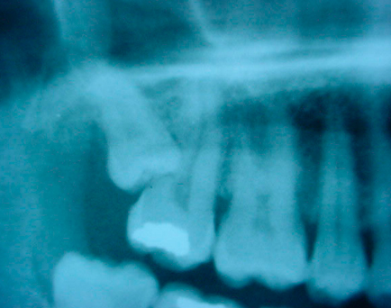 Radiografía de extracción de terceros molares