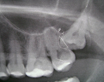 Radiografía de extracción de terceros molares