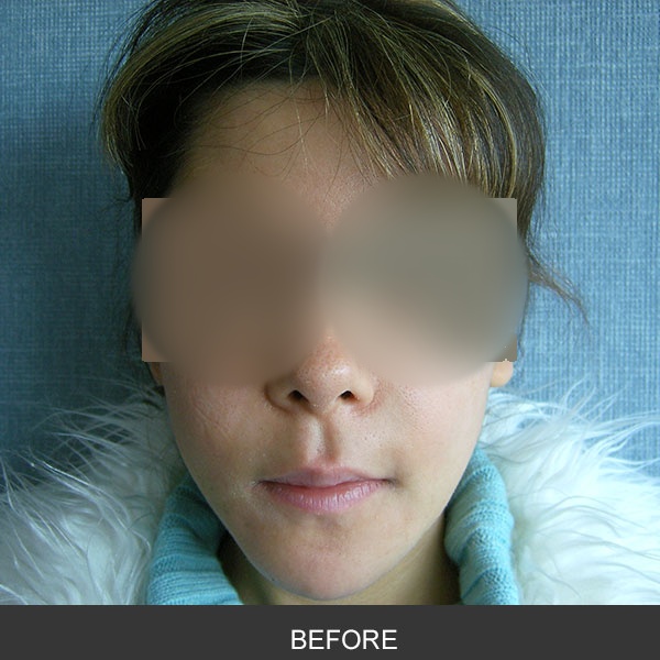 Removal of Silastic implant due to infection