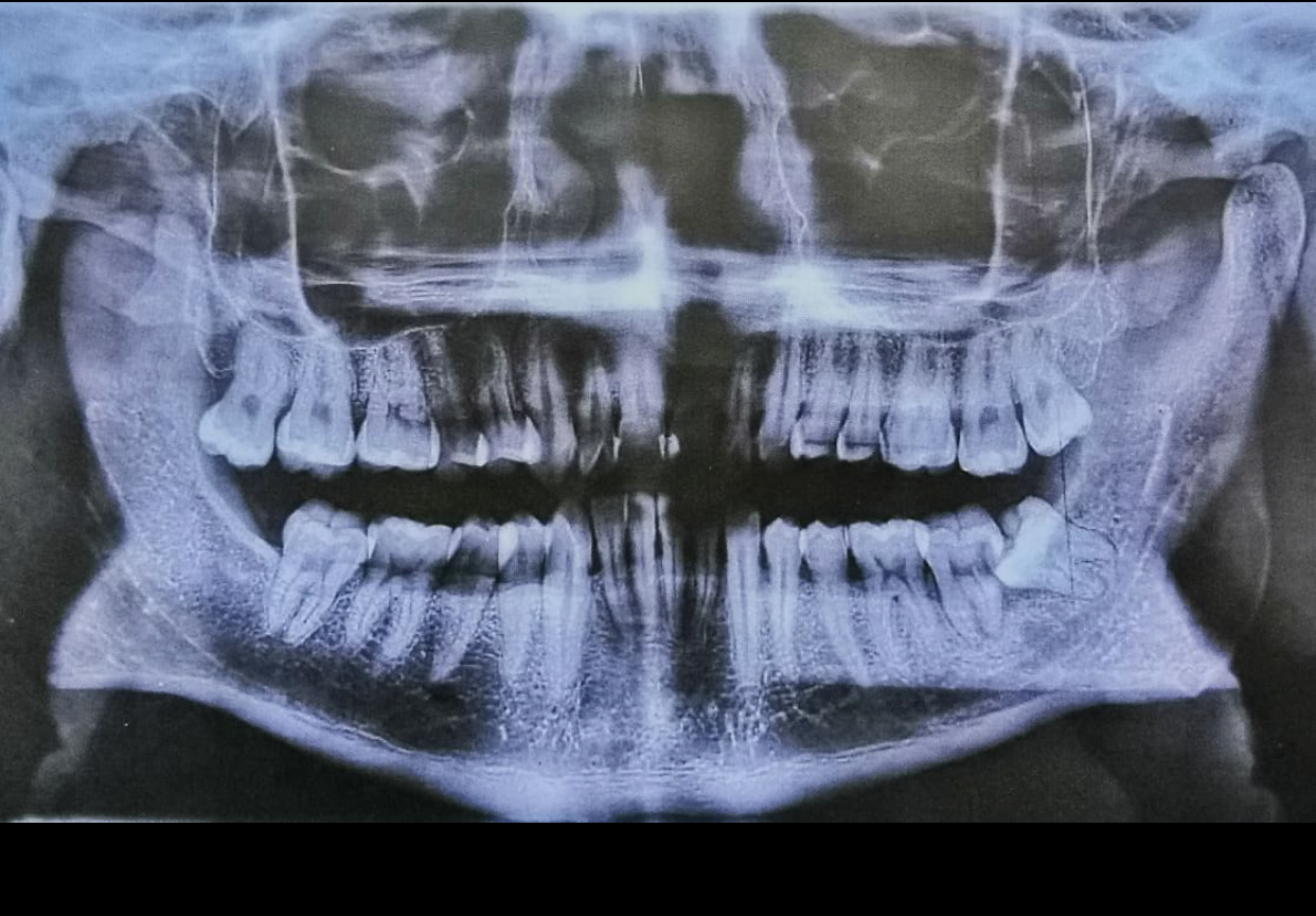 Pérdida de 2º molar por caries por 3er molar