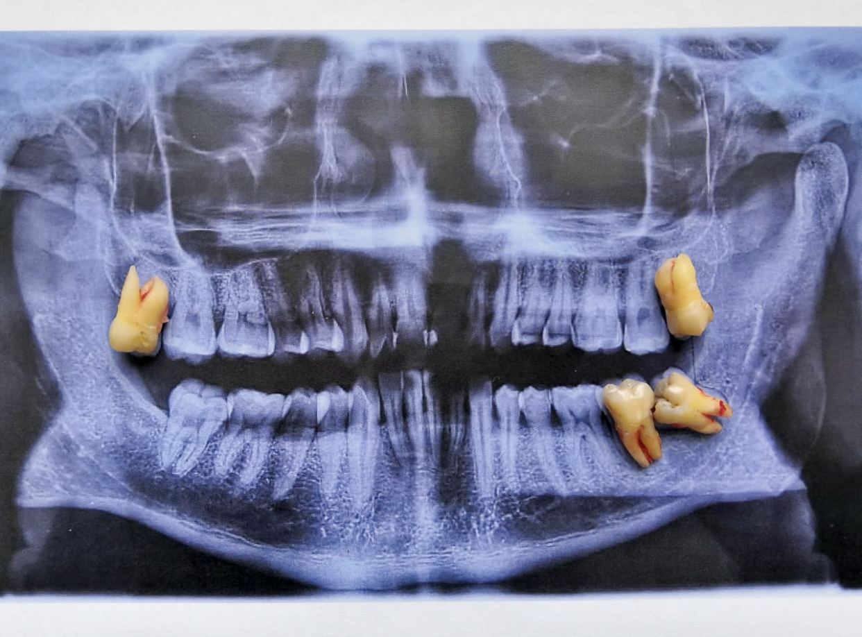 Pérdida de 2º molar por caries por 3er molar