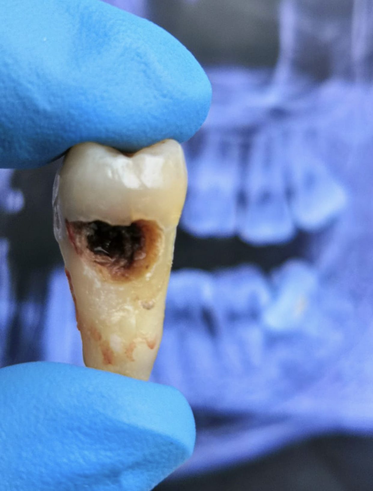 Pérdida de 2º molar por caries por 3er molar