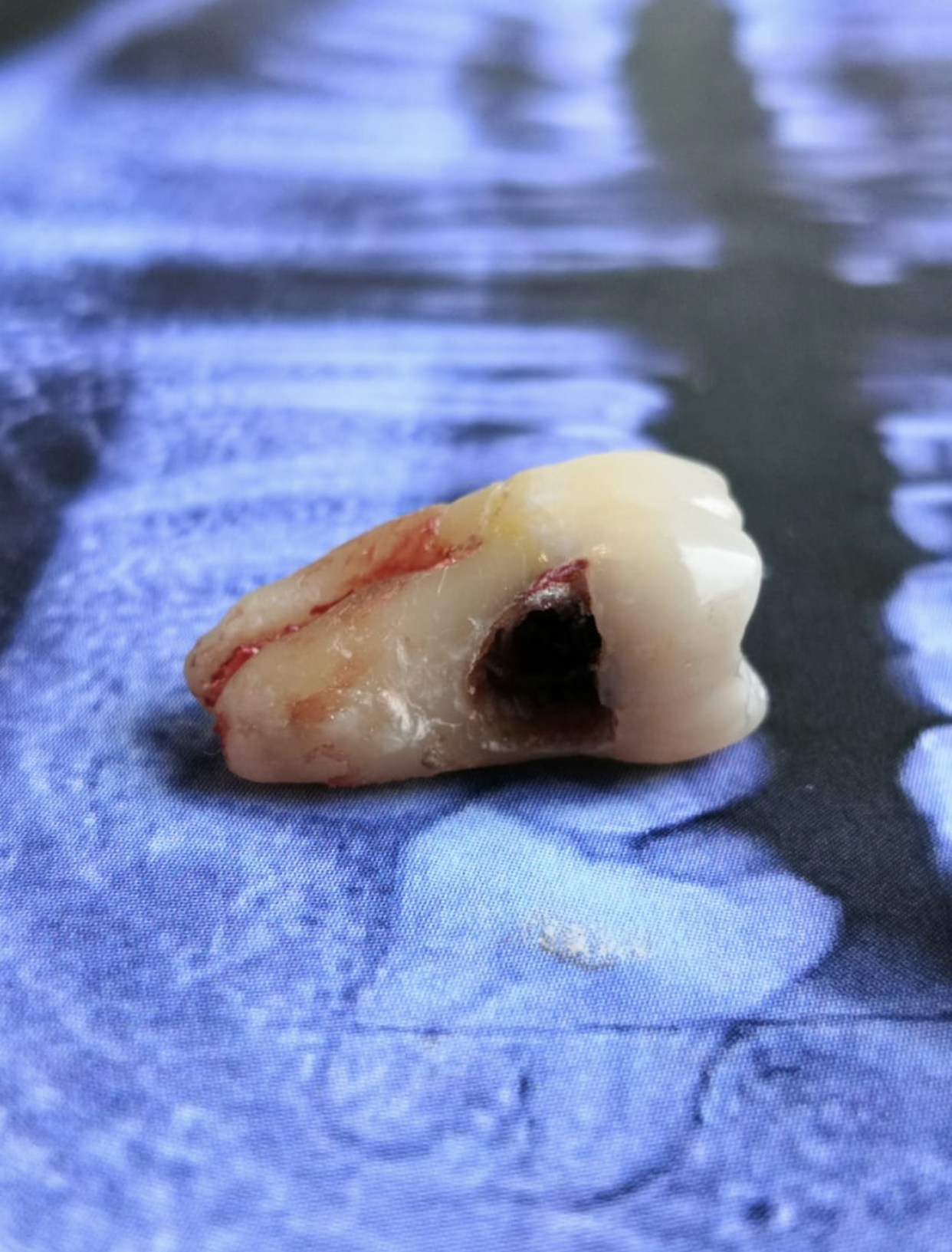 Pérdida de 2º molar por caries por 3er molar