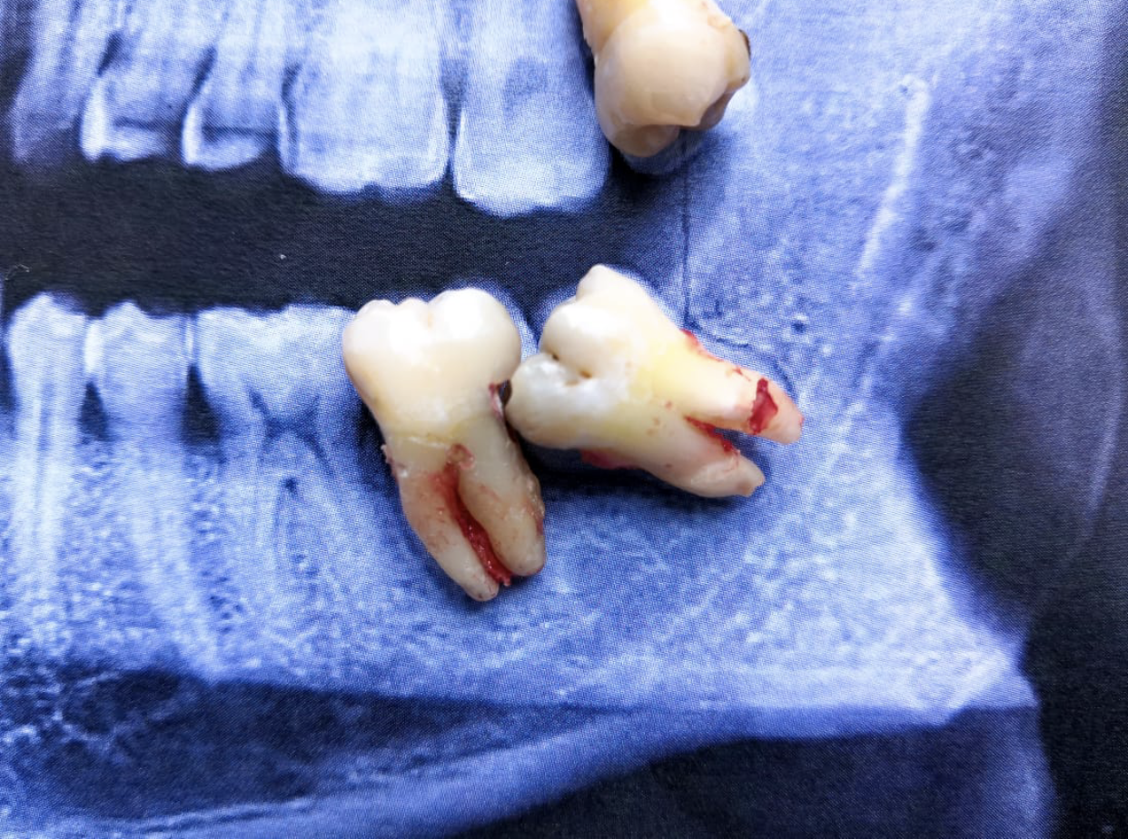 Pérdida de 2º molar por caries por 3er molar