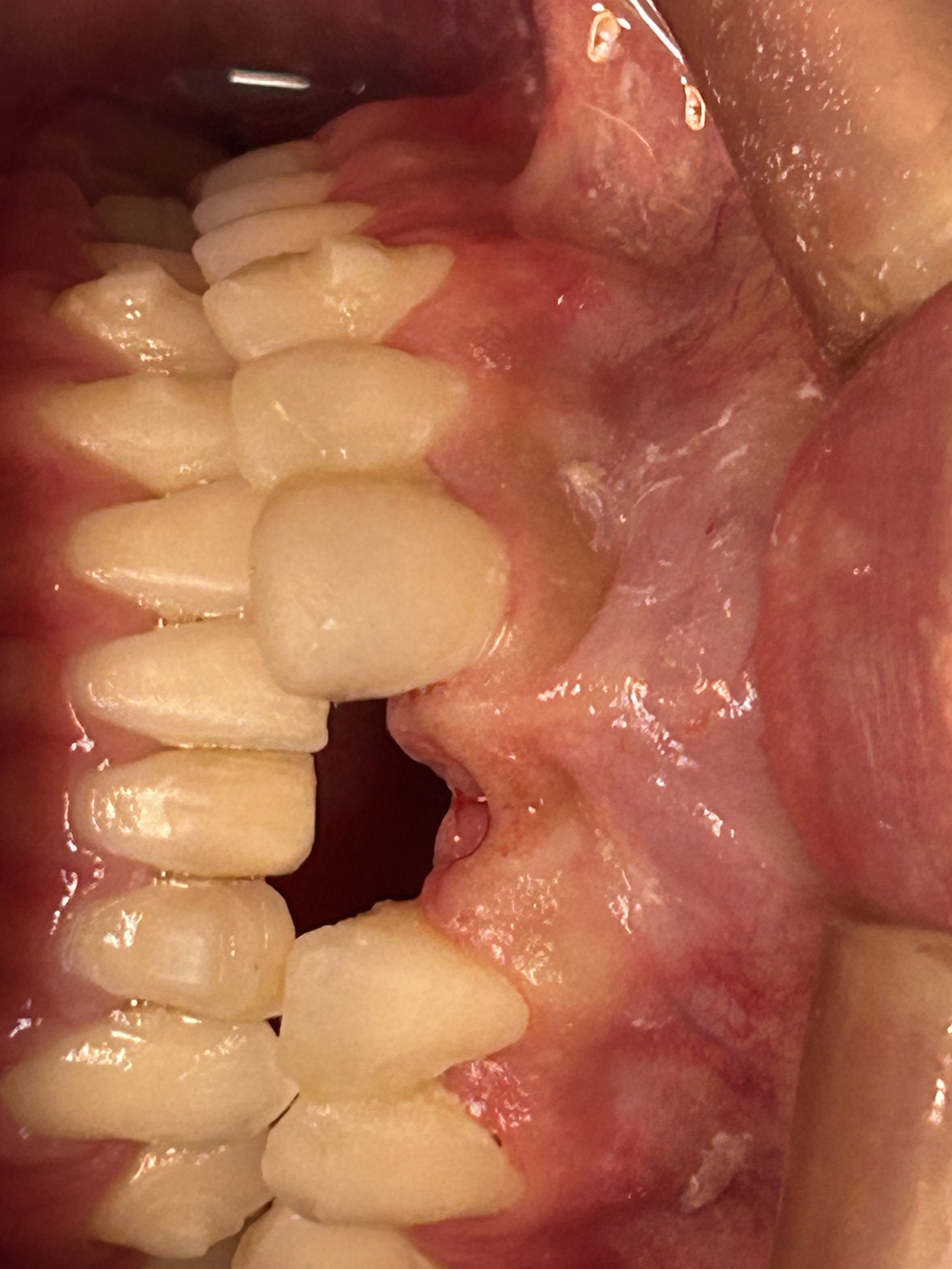 Caso: 2 implantes con reconstrucción