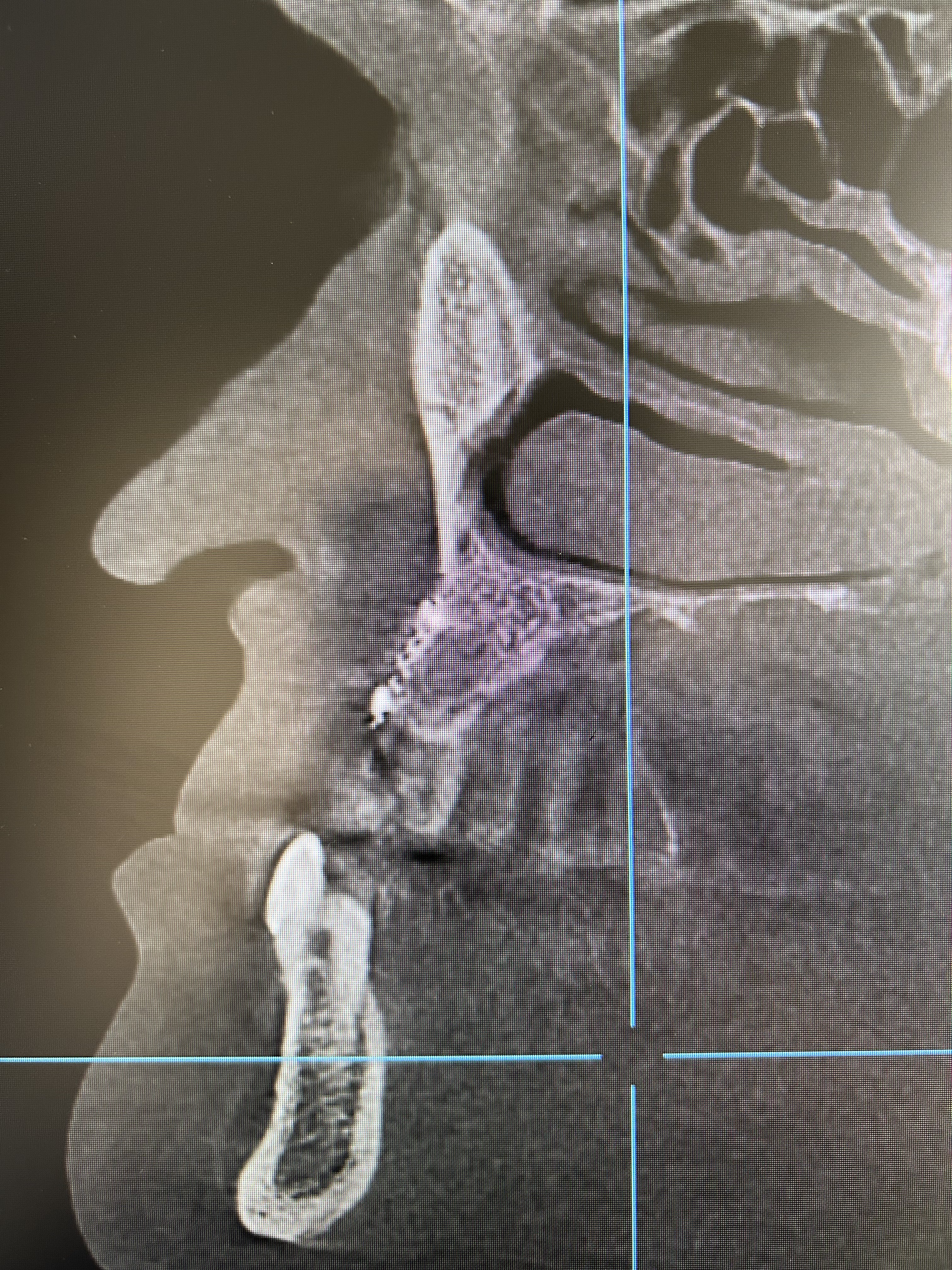 Caso: 2 implantes con reconstrucción