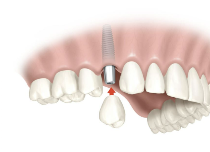Diagrama de implantes dentales