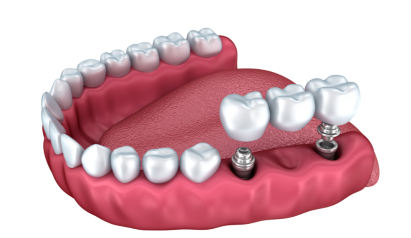 Diagrama de implantes dentales