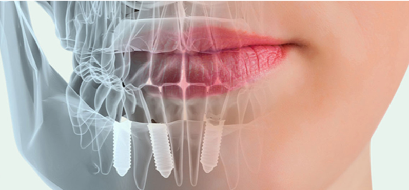 Diagrama de implantes dentales
