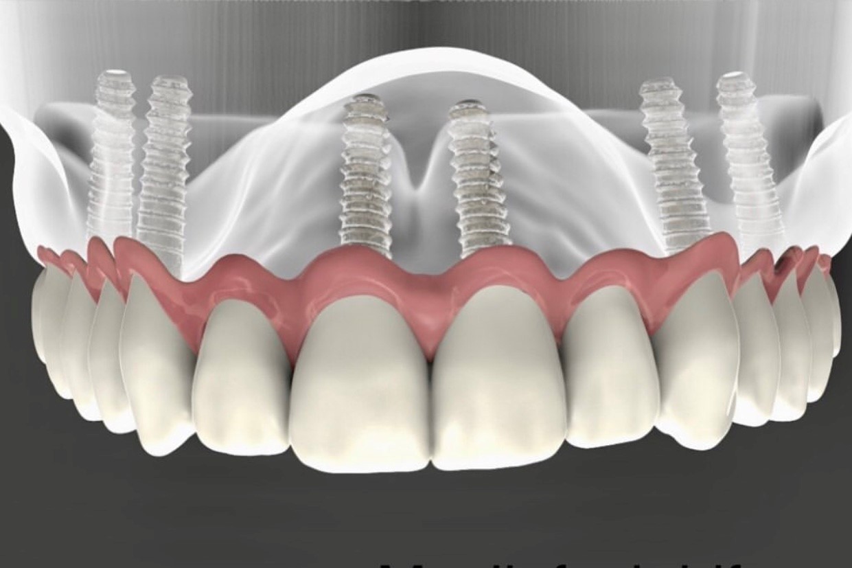 Implantes dentales (promocional)