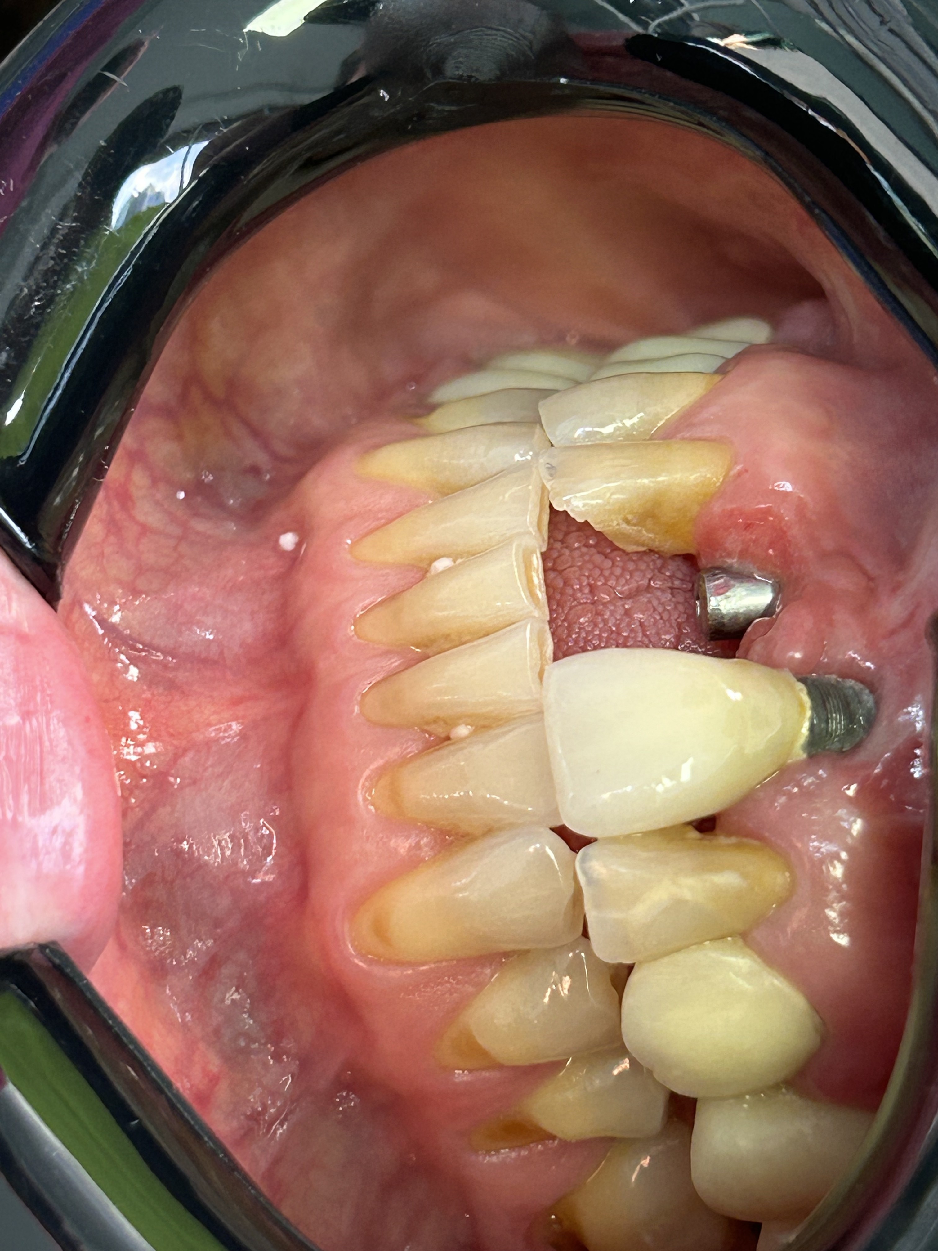 Periimplantitis
