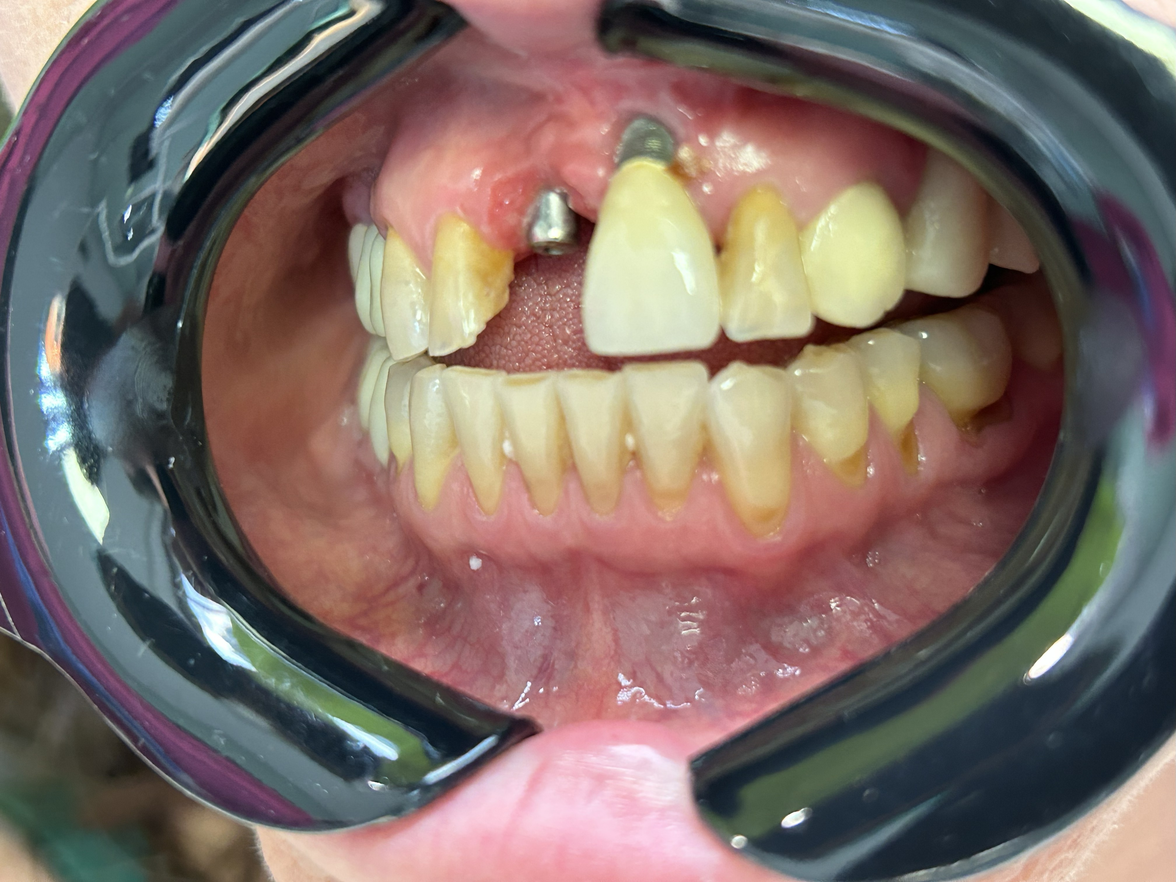Periimplantitis