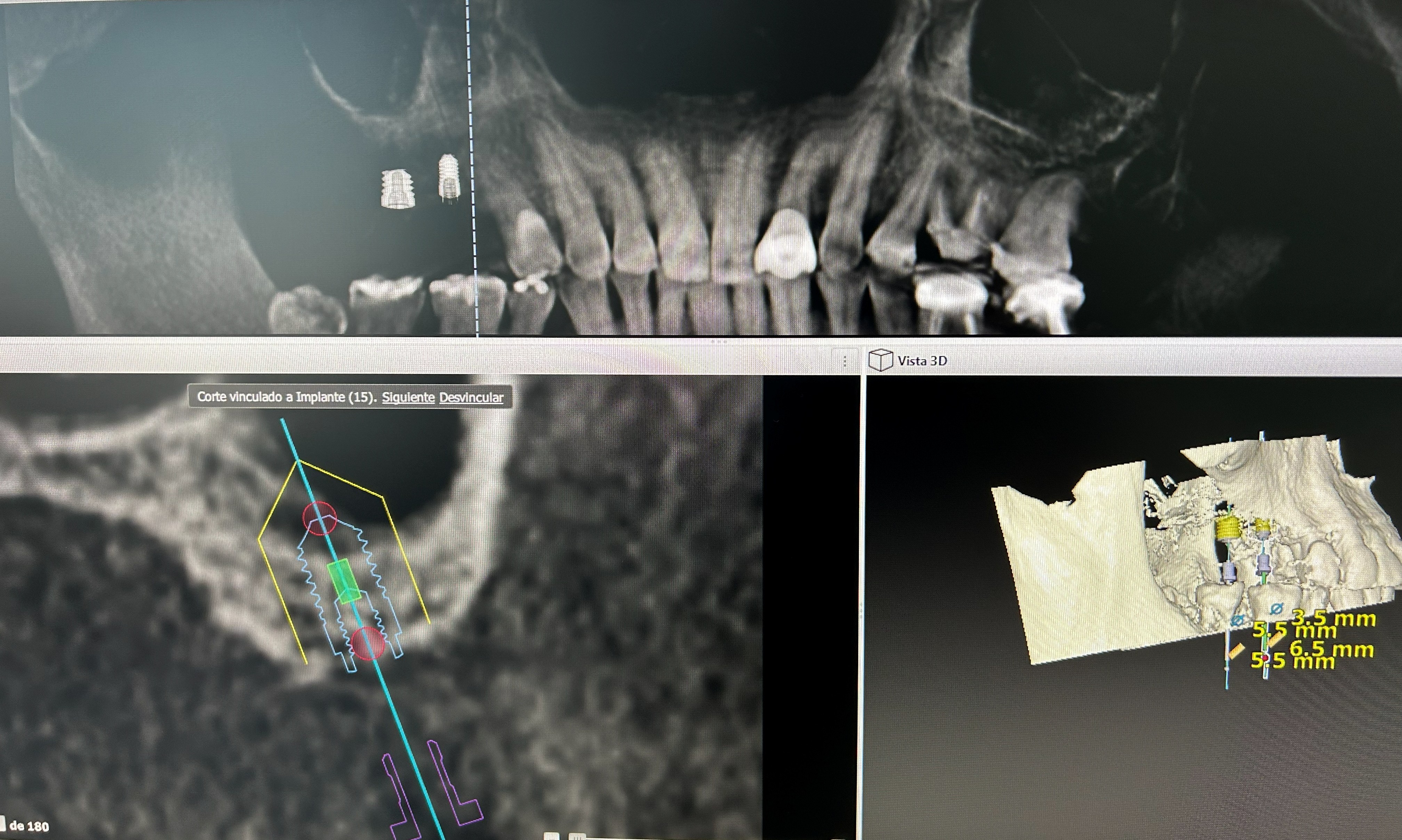 Implantes extra cortos