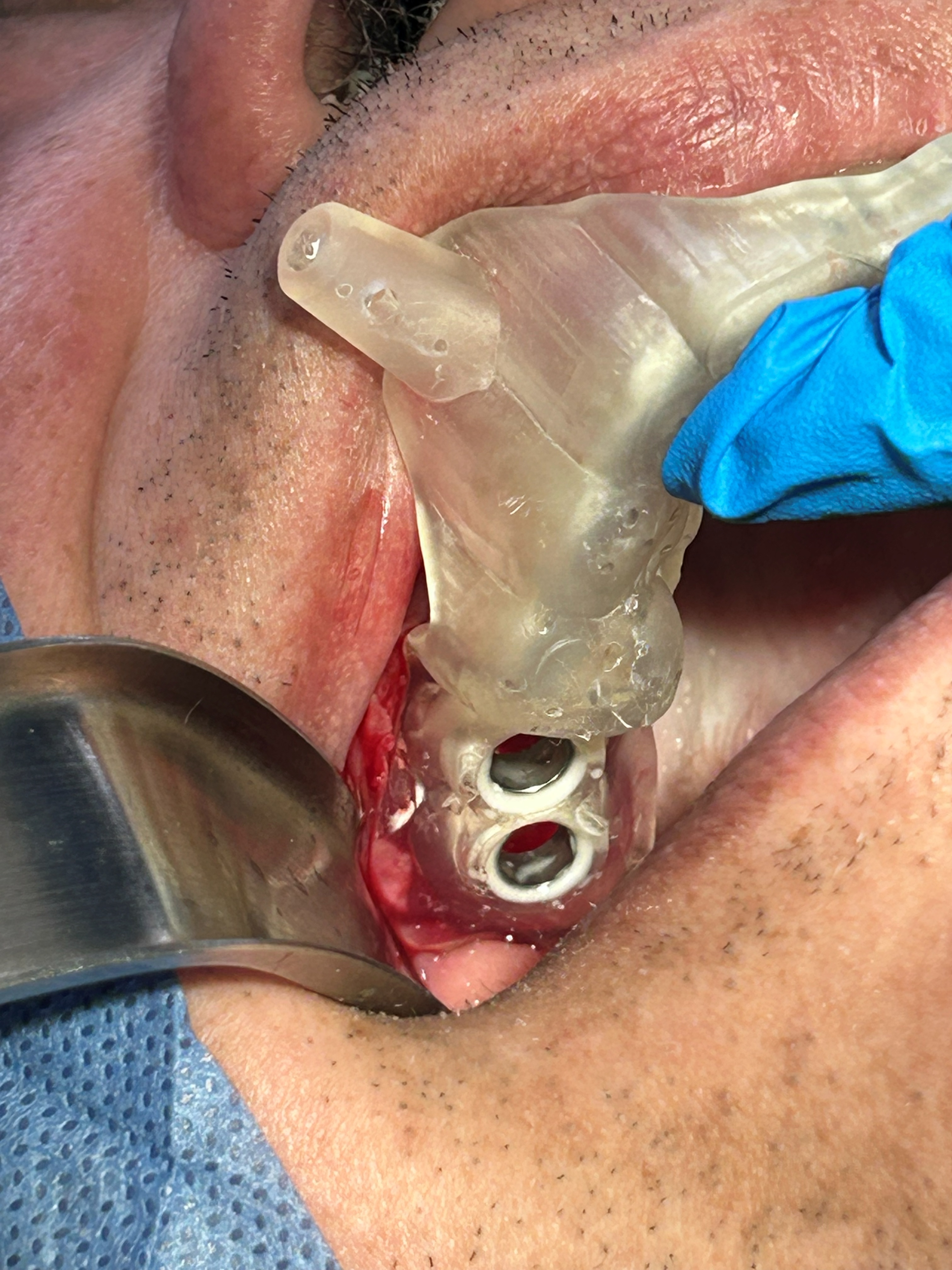 Implantes extra cortos