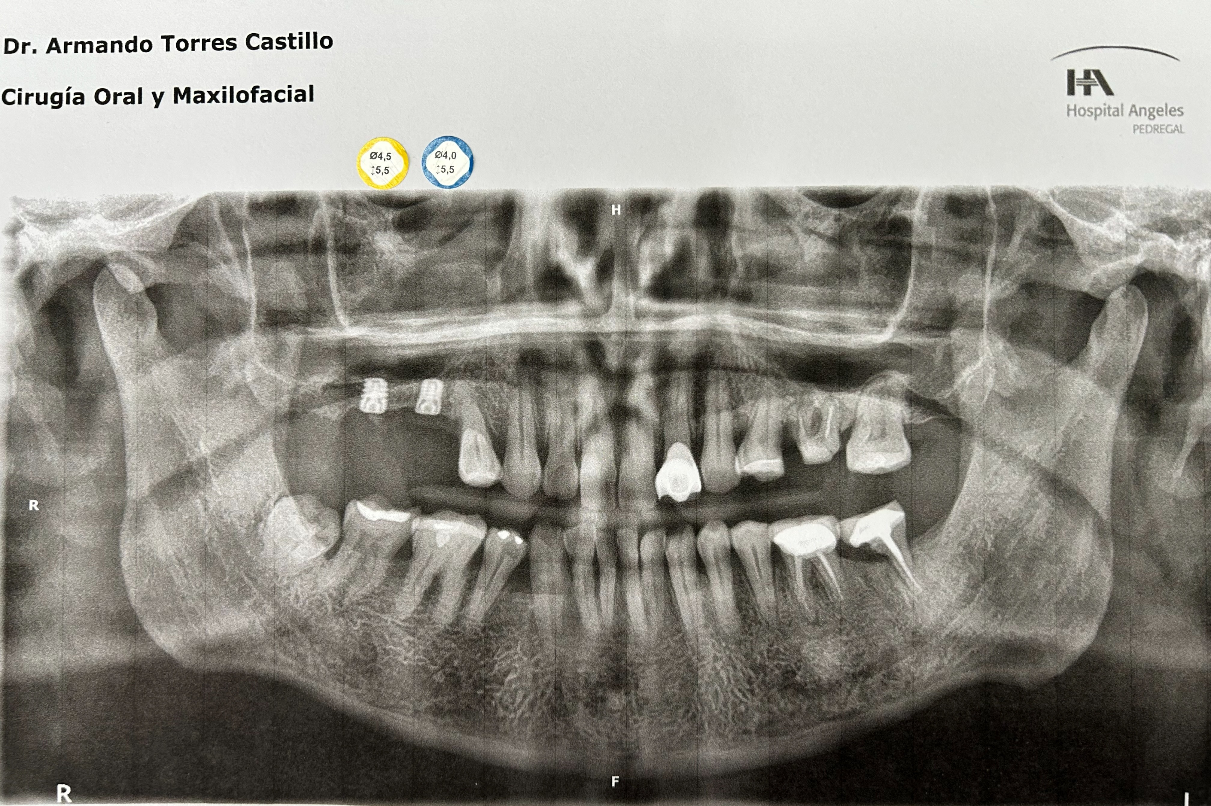 Implantes extra cortos