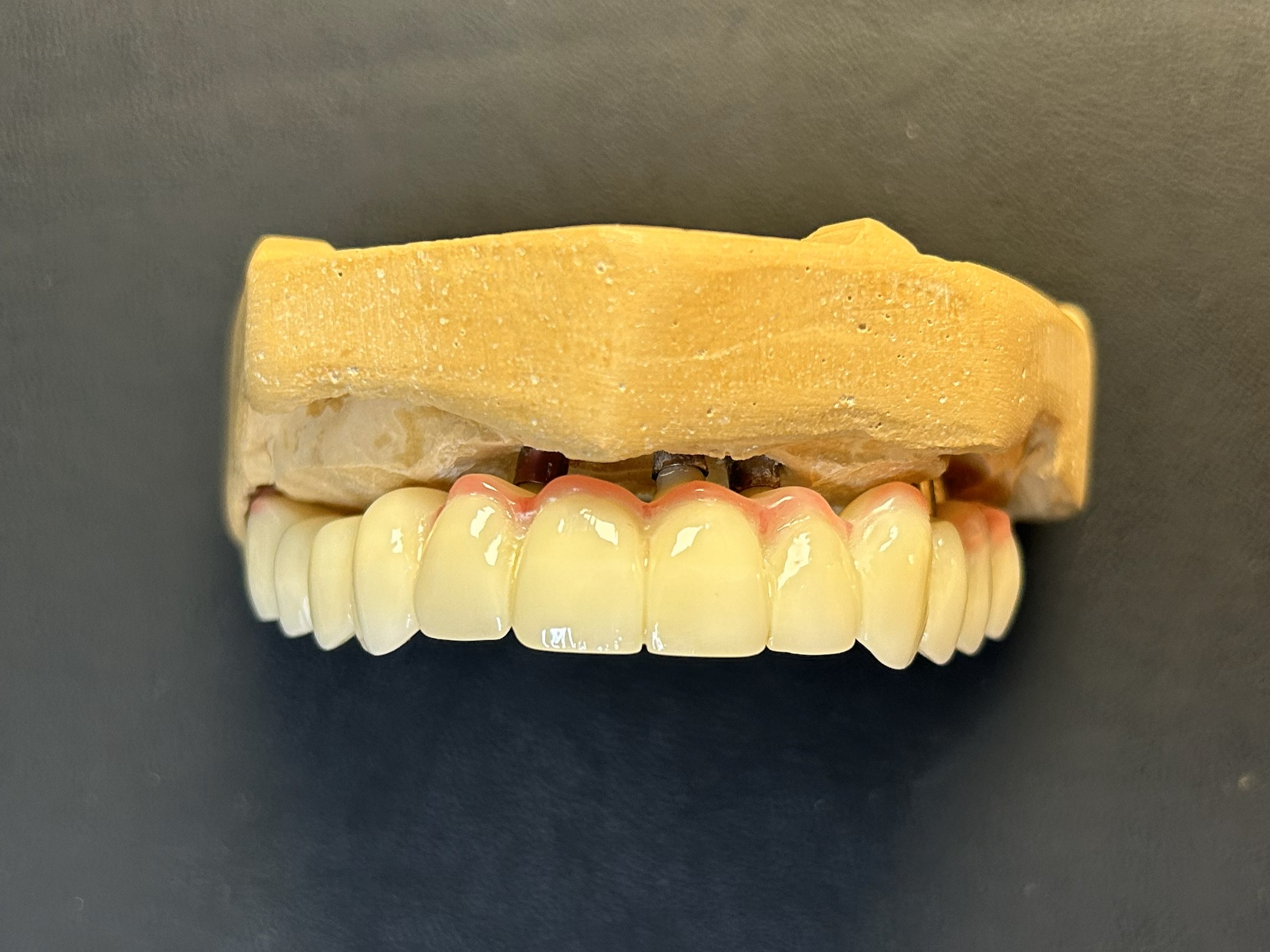 Rehabilitación protésica sobre implantes dentales