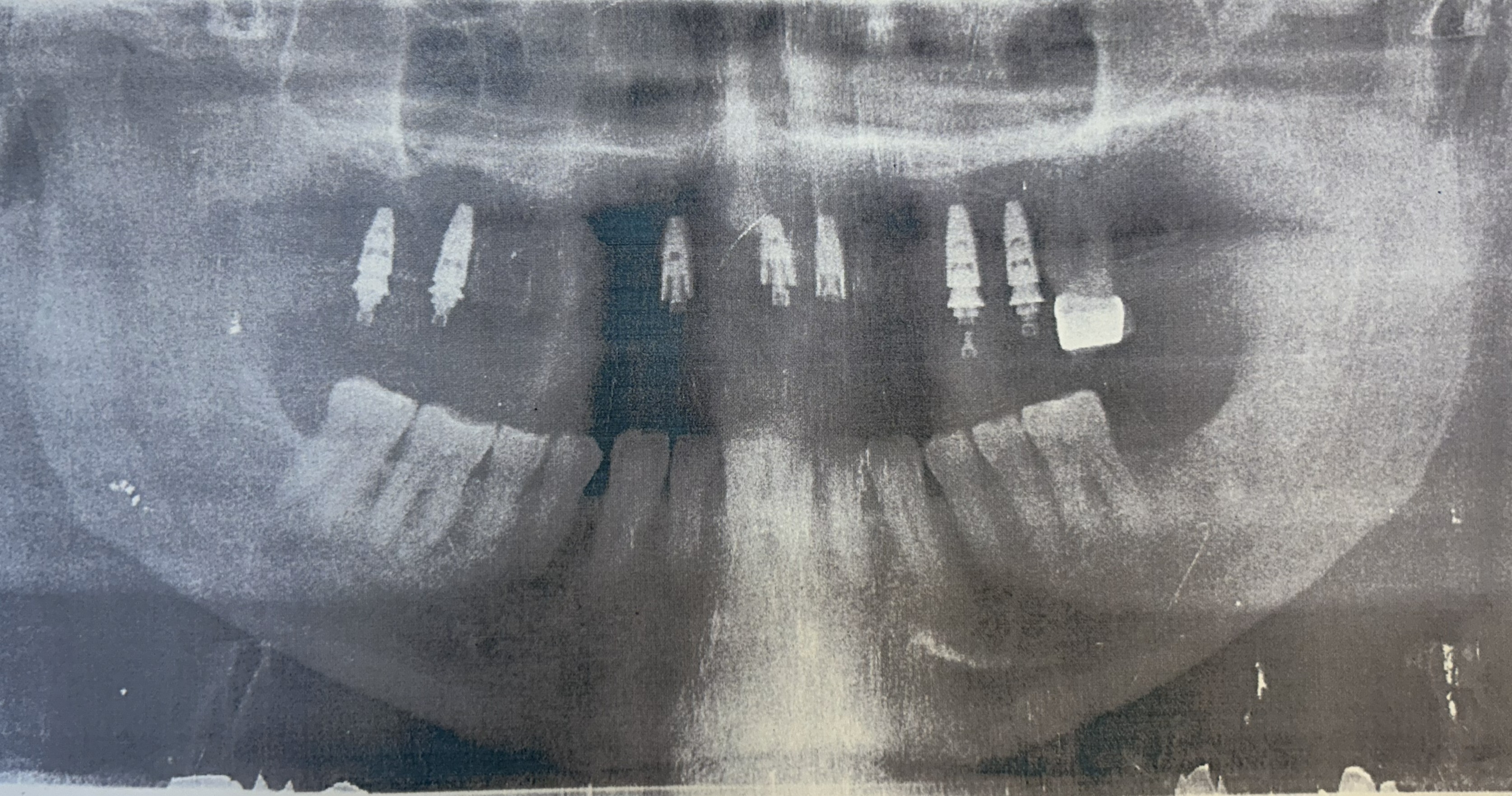 Rehabilitación protésica sobre implantes dentales