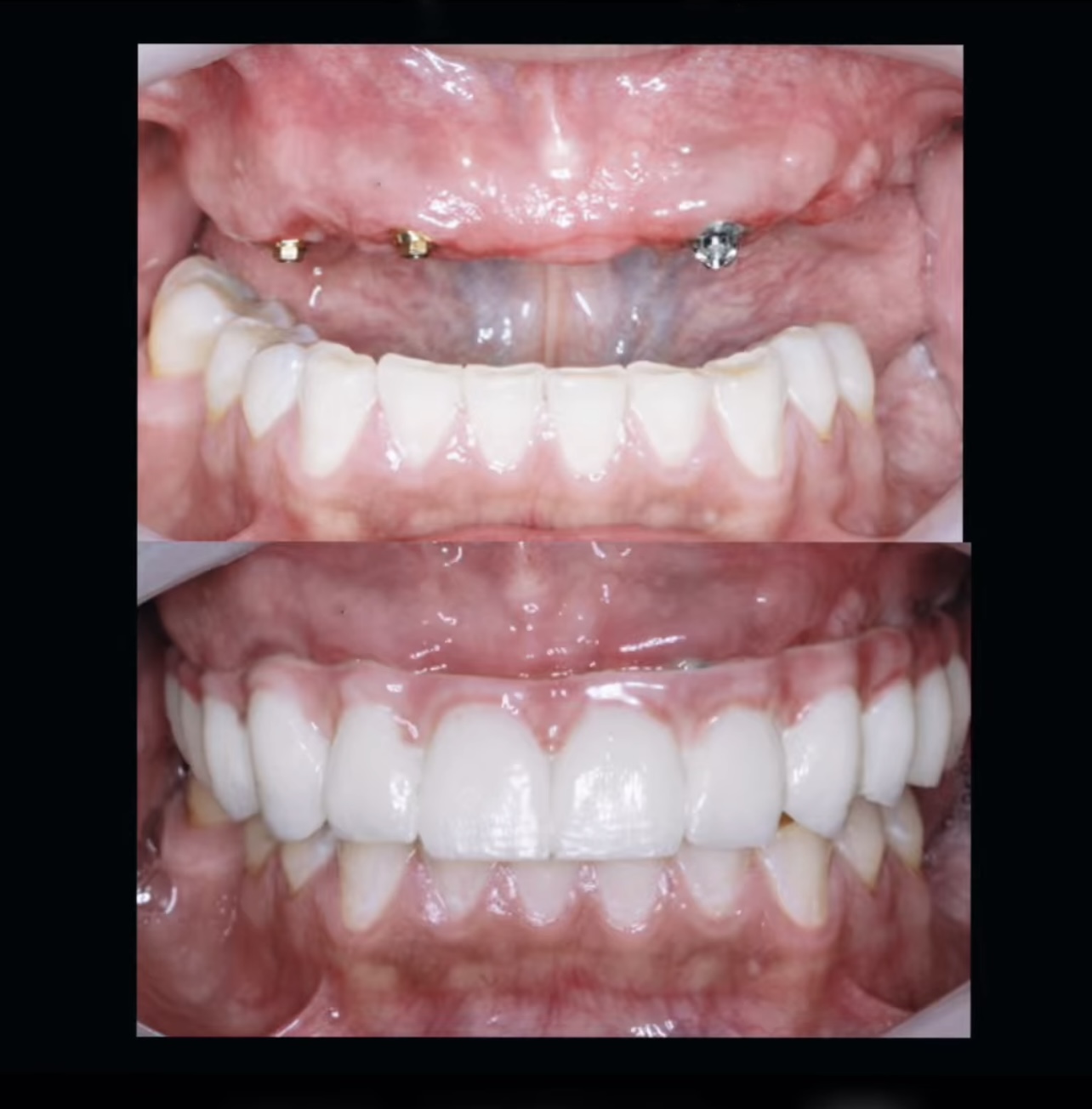 Rehabilitación protésica sobre implantes dentales