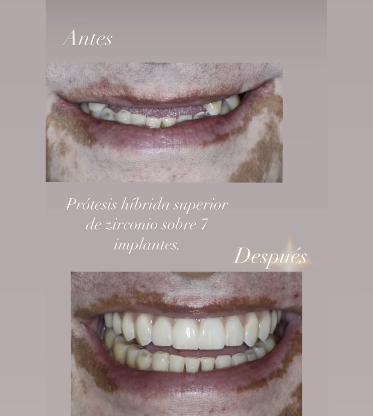 Rehabilitación protésica sobre implantes dentales