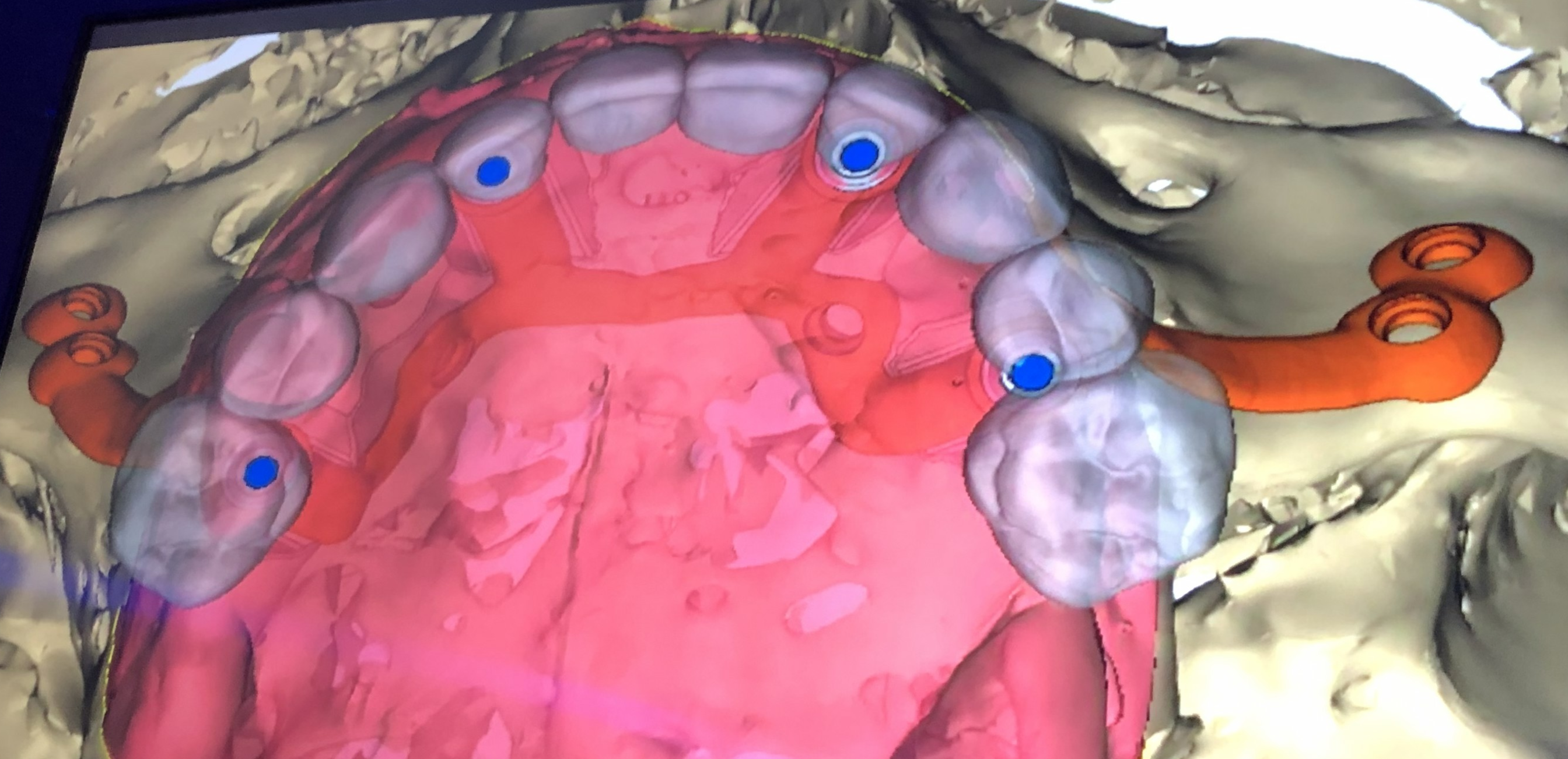 Implantes subperiósticos (IMP)