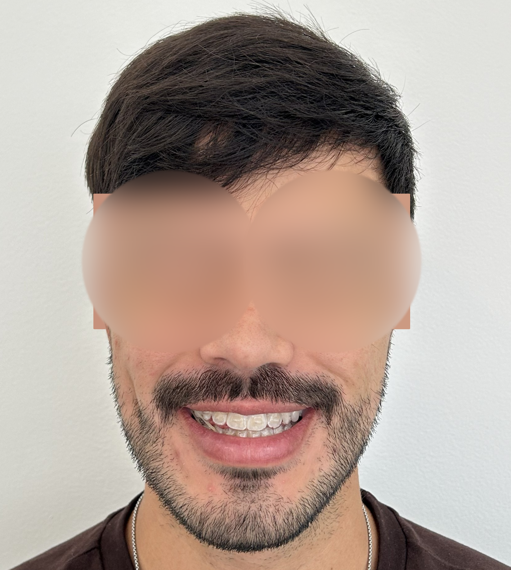 Antes
