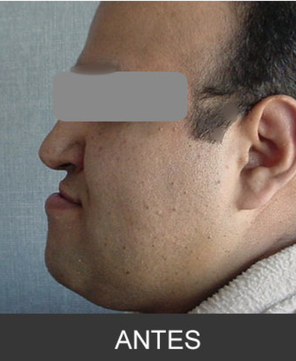 Antes