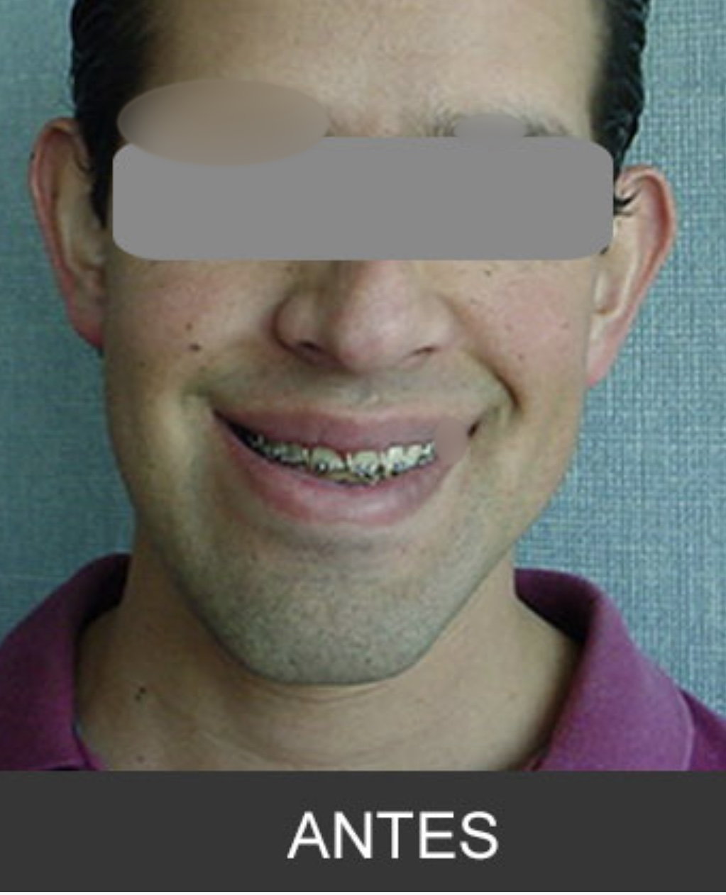 Antes