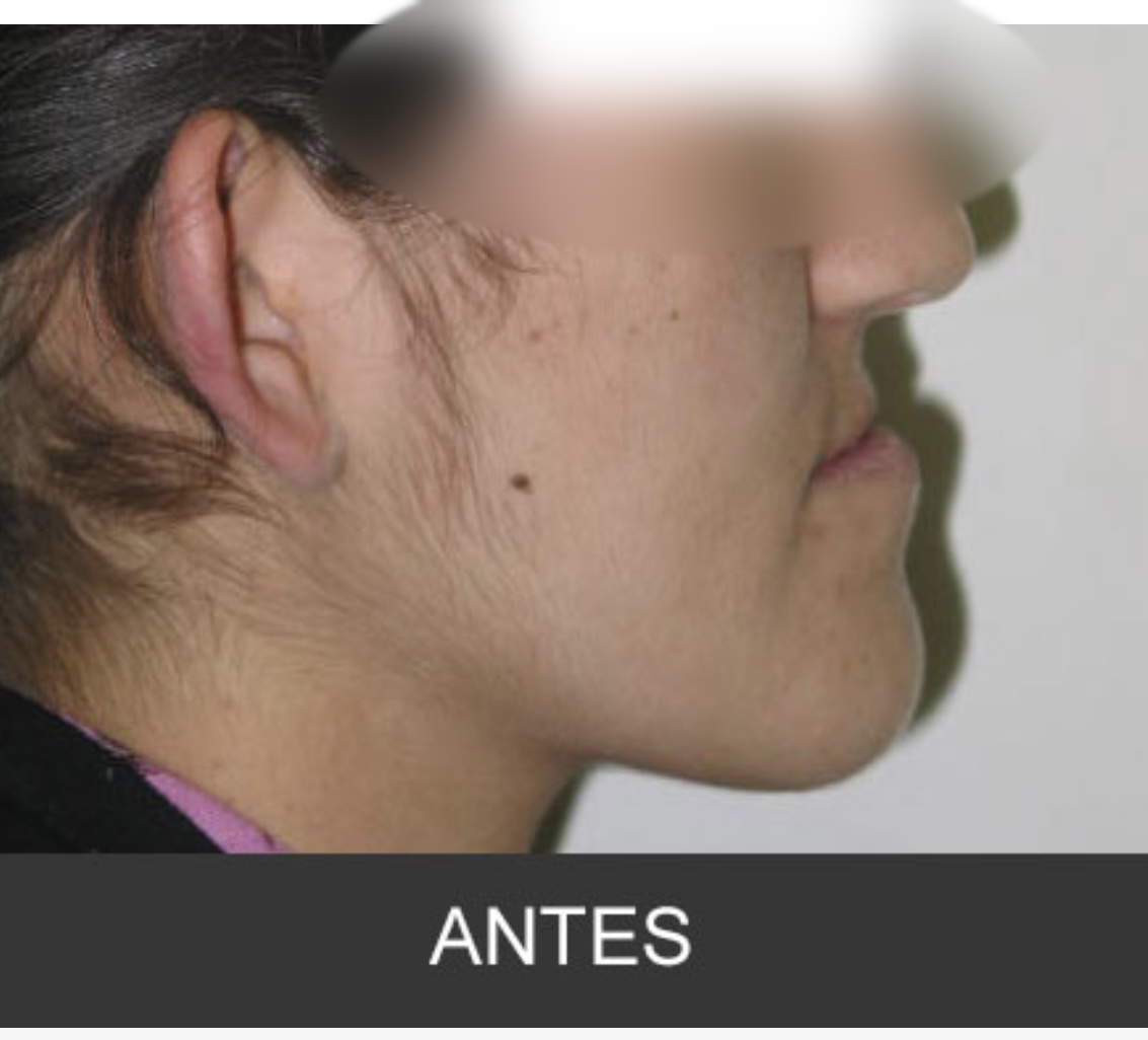 Antes