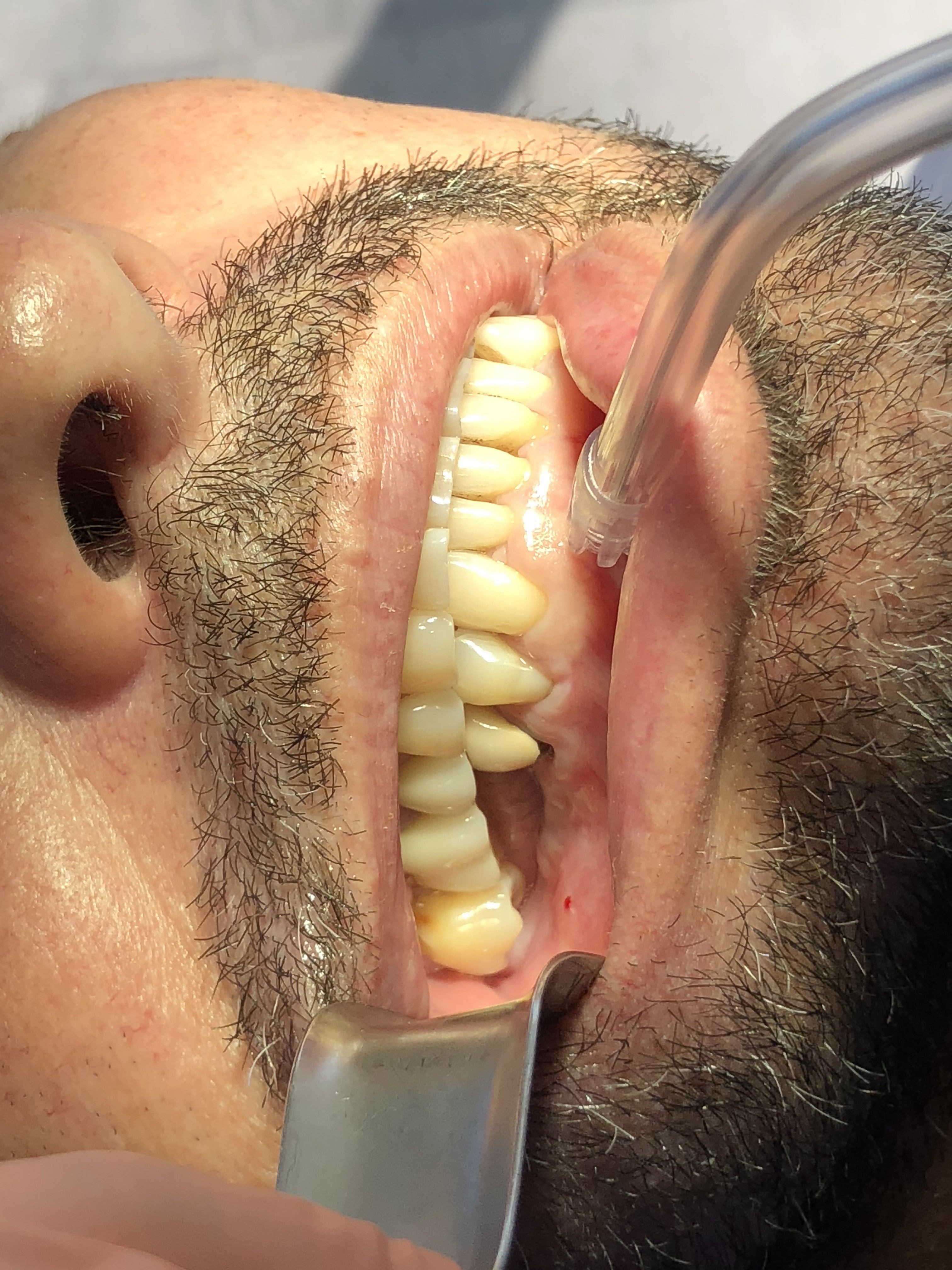 Pérdida dental y colapso de la mordida
